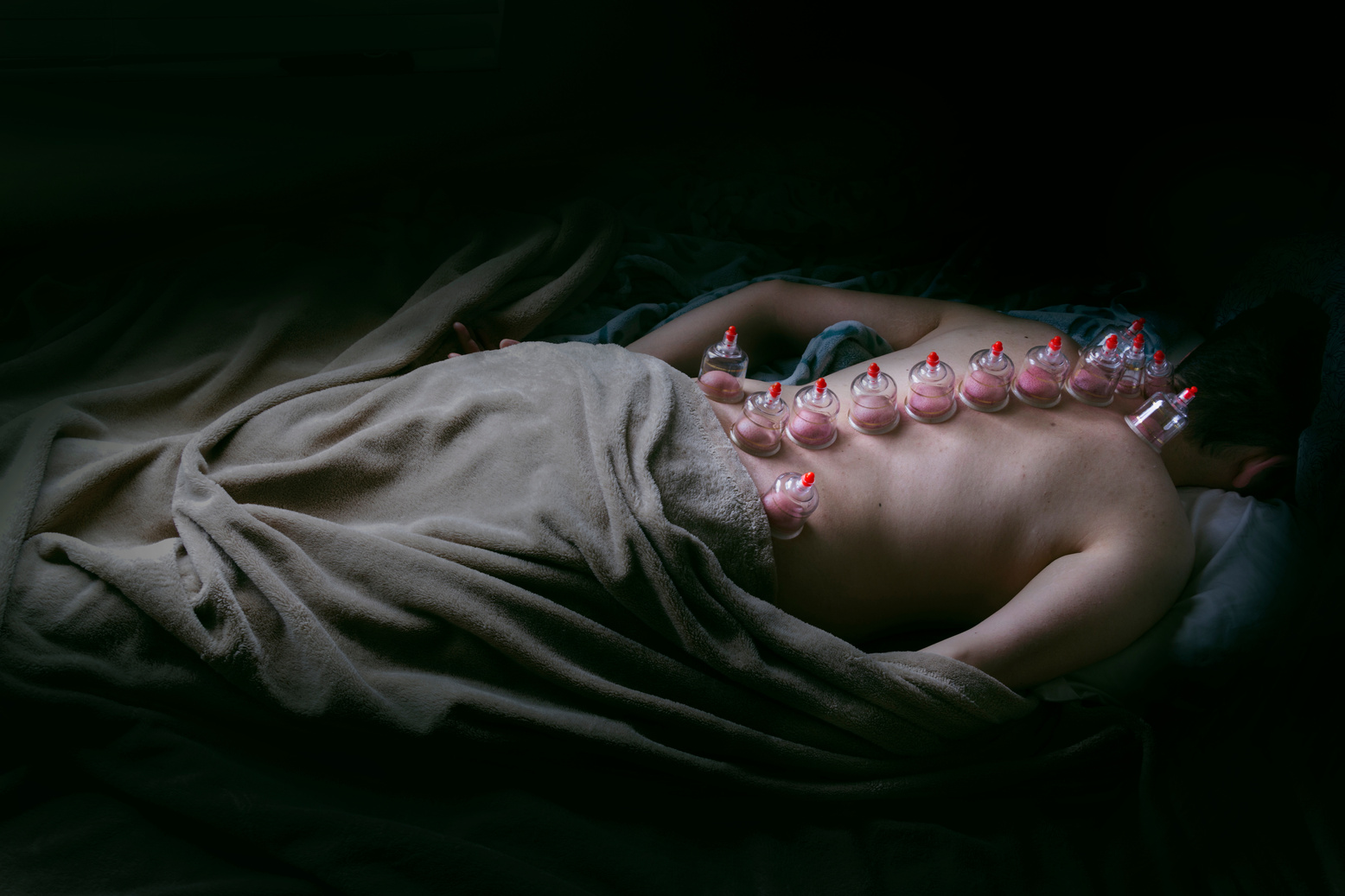 Cupping Therapy
